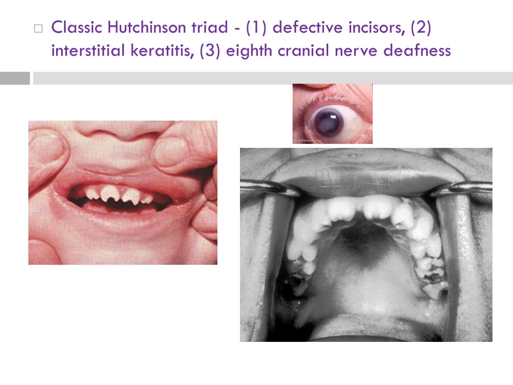 PPT Pengendalian Bayi dari Ibu SIFILIS PowerPoint Presentation, free download ID5950151