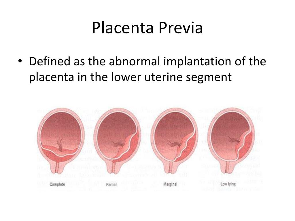 PPT Thi rd trimester bleeding and management PowerPoint Presentation