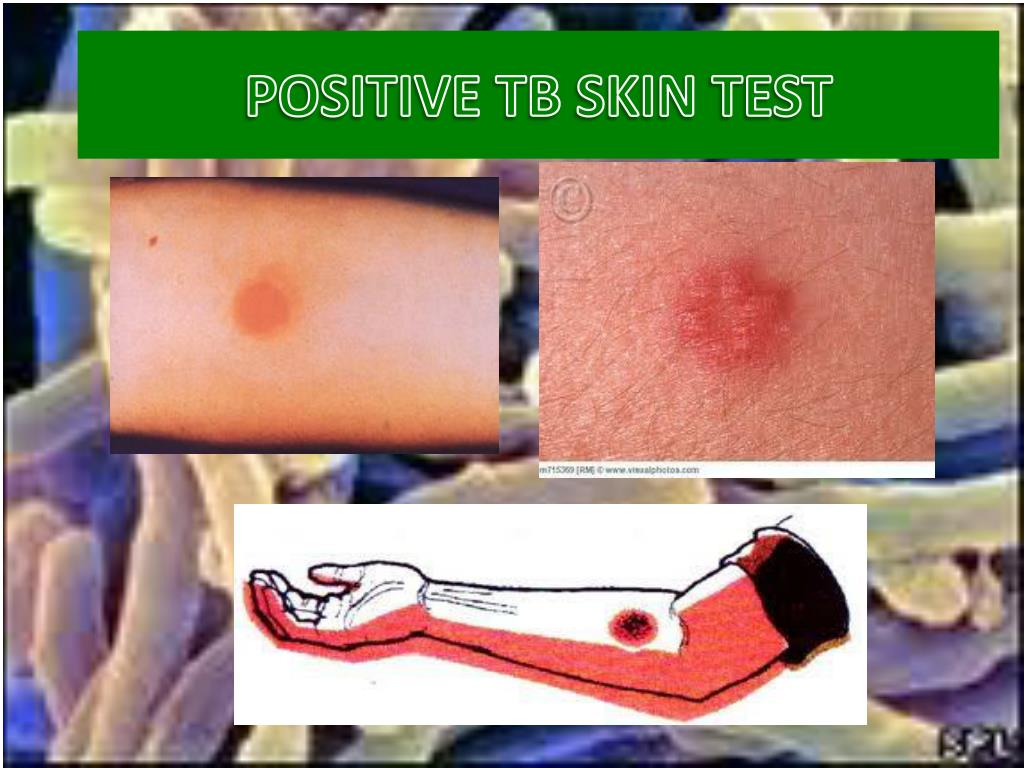 photos of positive tb skin test