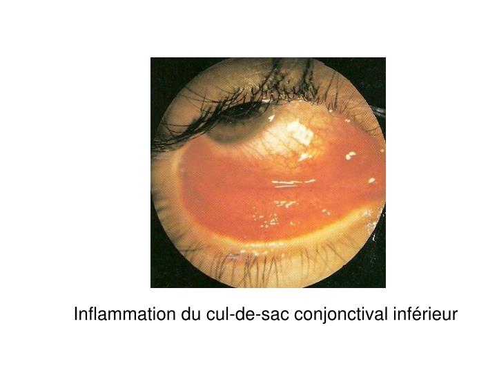 Cul De Sac Conjonctival Inferieur De L Oeil