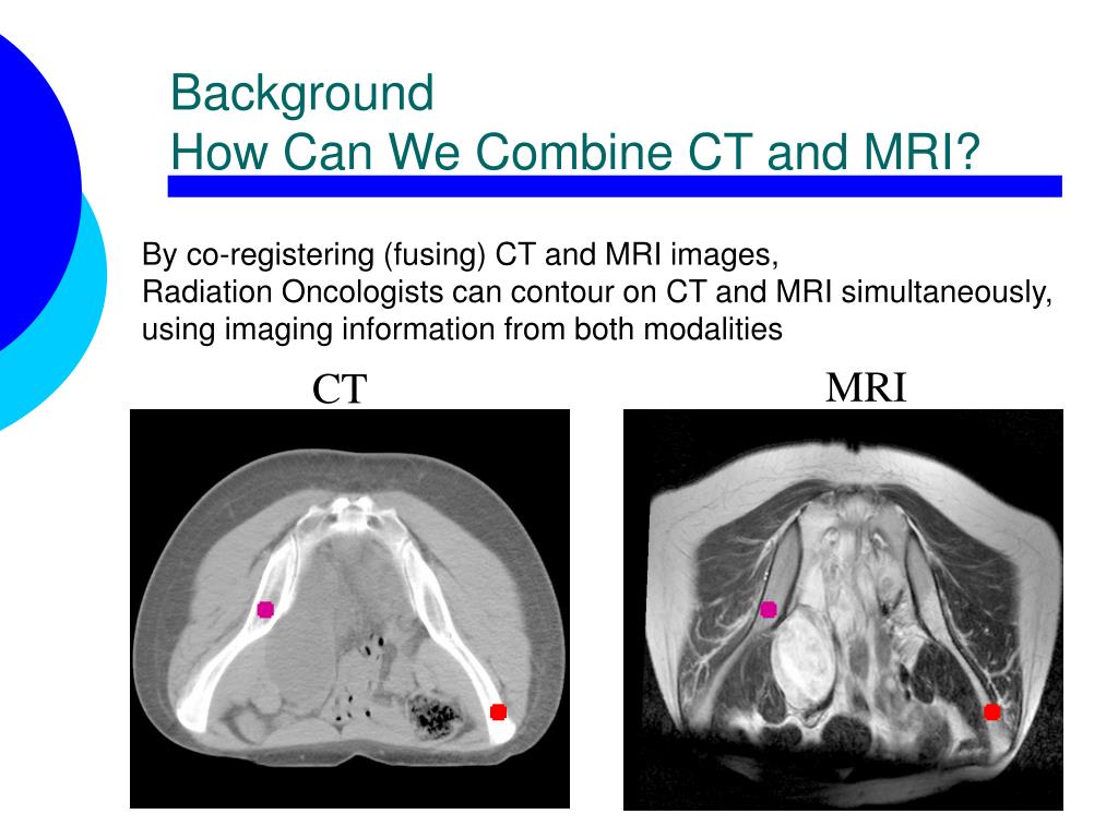 PPT - Hit or Miss: Is there a role for CT/MRI fusion in Sarcoma ...