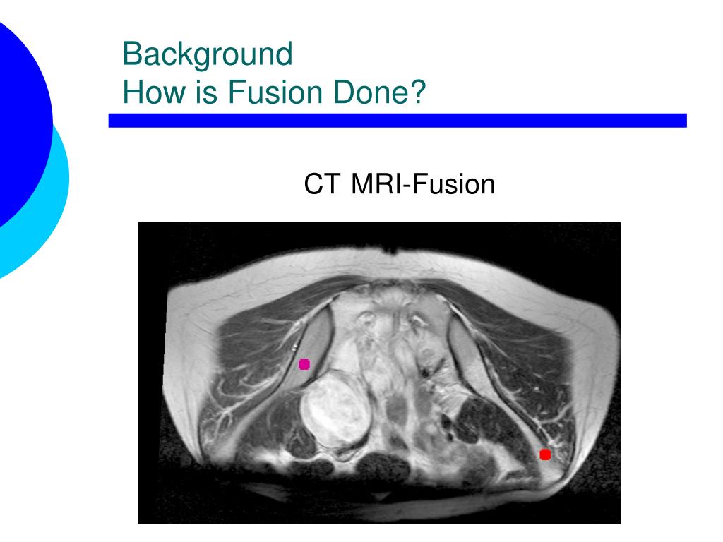 PPT - Hit or Miss: Is there a role for CT/MRI fusion in Sarcoma ...