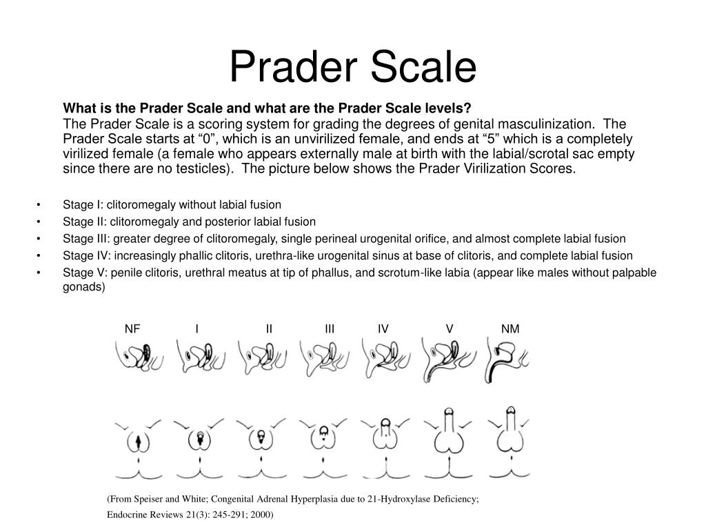 PPT - Prader Scale PowerPoint Presentation, free download - ID:6016486