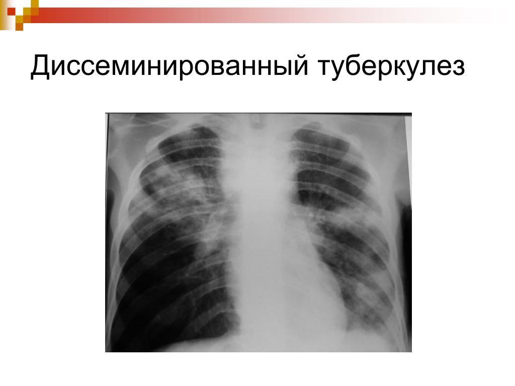 Формы диссеминированного туберкулеза. Подострый диссеминированный туберкулез рентген. Милиарный диссеминированный туберкулез рентген. Диссеминированный туберкулез протокол рентген. Диссеминированный инфильтративный туберкулез.