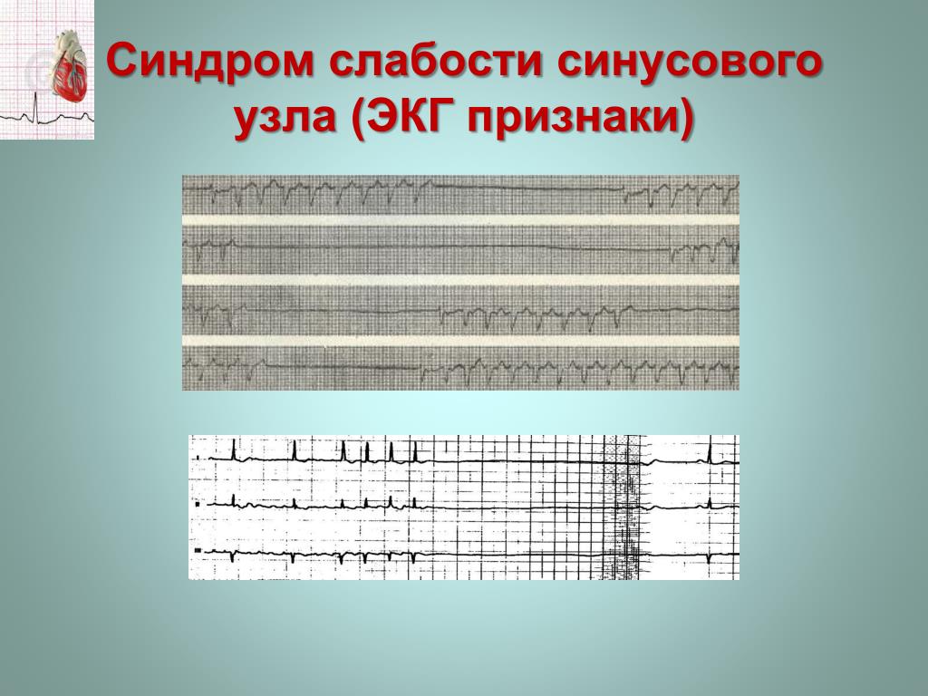 Синусовая вегетативная дисфункция