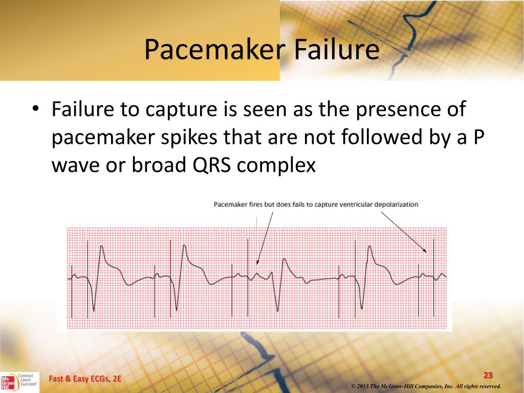 a paced with failure to capture