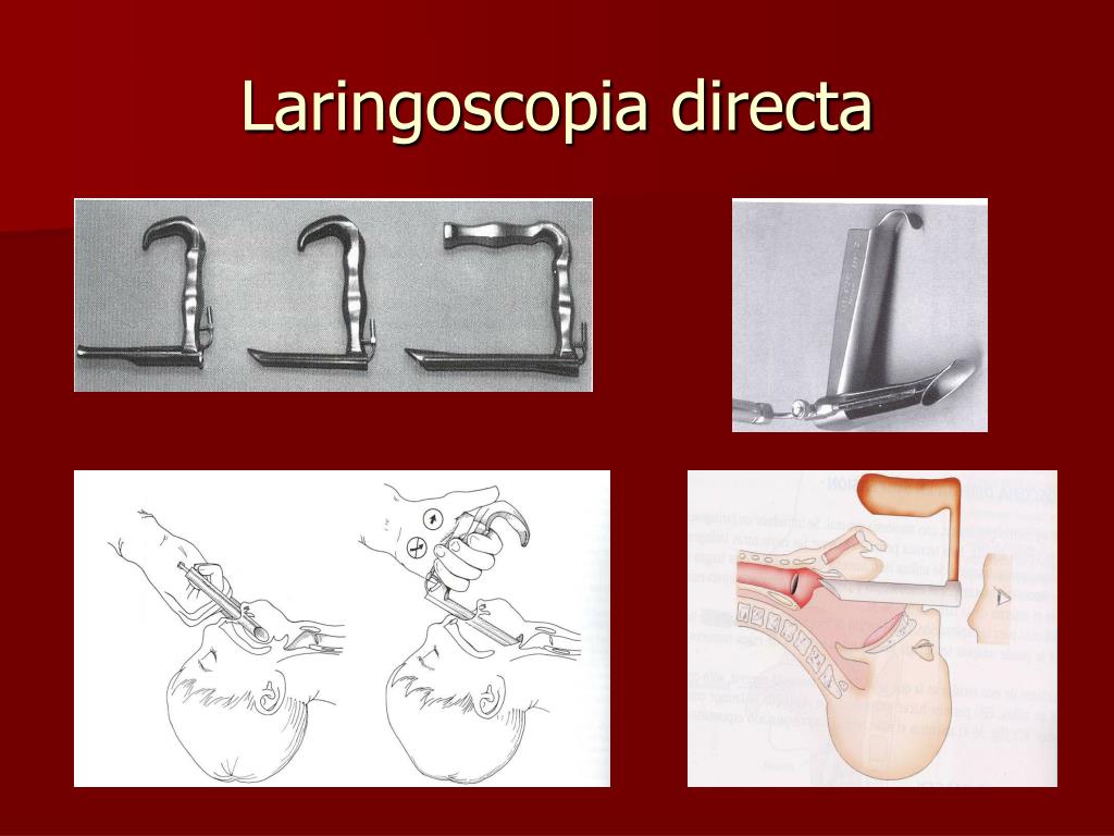Differenza Tra Laringoscopia E Fibrolaringoscopia PPT - MALFORMACIONES DE LA LARINGE TRAUMATISMOS CUERPOS EXTRAÑOS