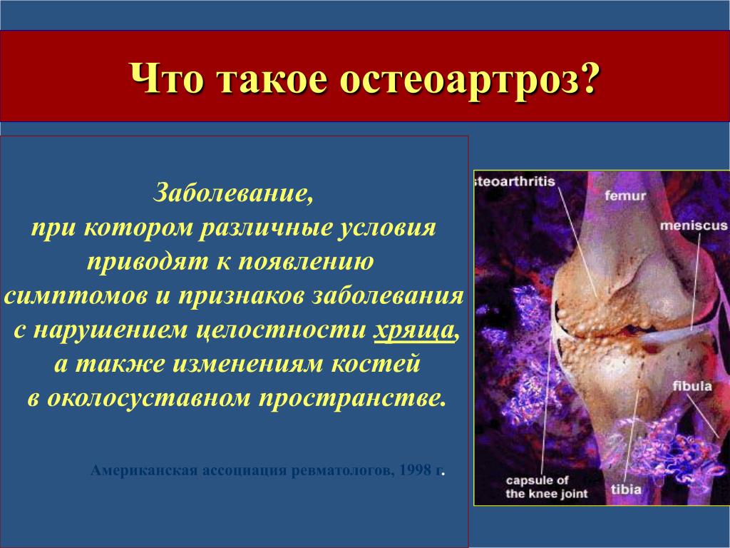 Чем остеоартроз отличается от артрита. Артрит и артроз: в чем разница, симптомы, лечение Чем отличается остеоартроз от остеоартрита | Osteoporoz.ru Чем отличается артрит от артроза? Разница в симптомах, диагностике и.