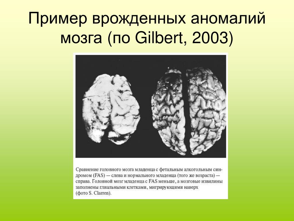 Мозг новорожденного масса. Врожденные аномалии мозга. Врожденные патологии примеры.