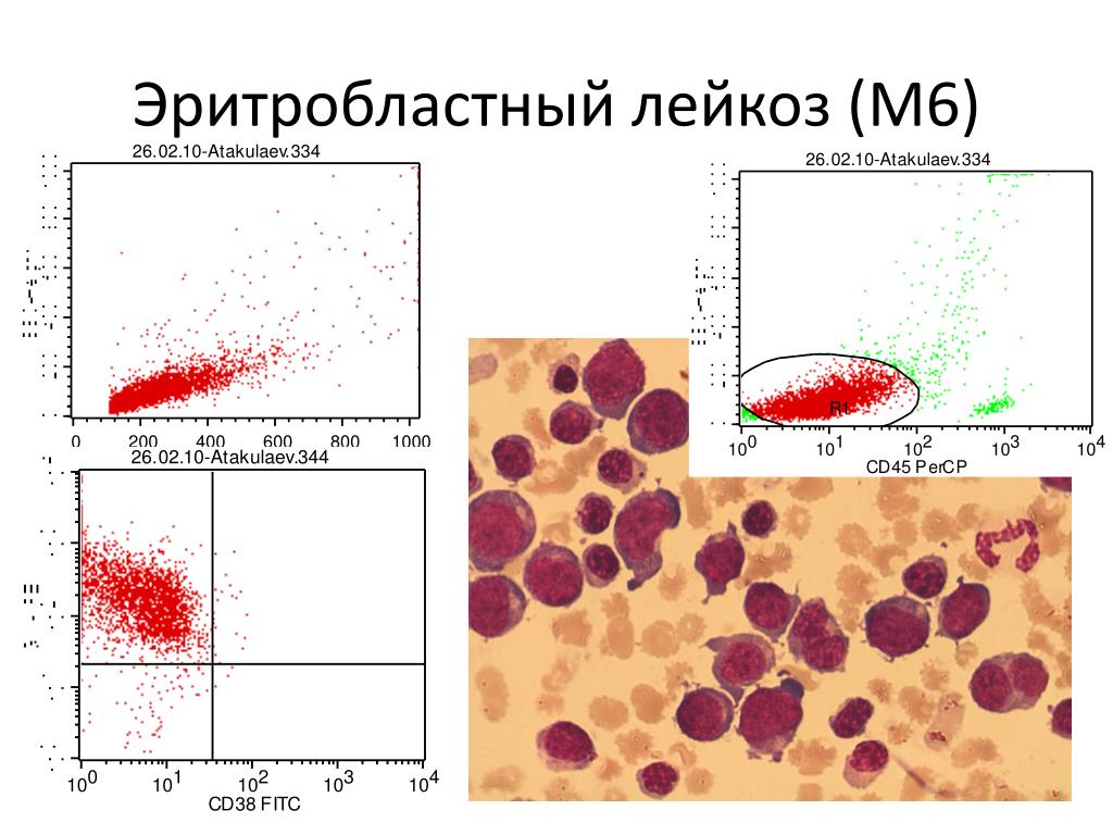 Тесты острые лейкозы