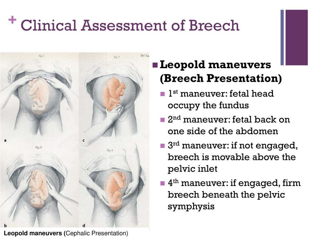 breech presentation symptoms