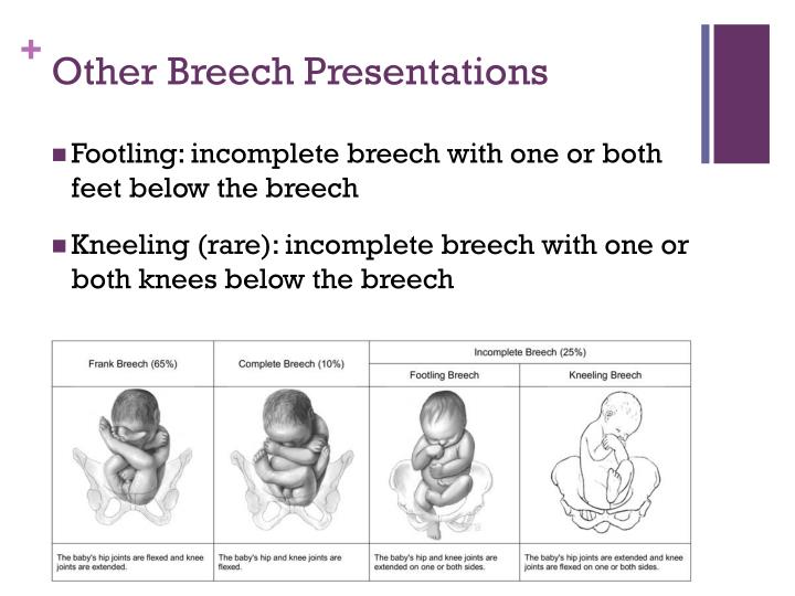 breech presentation types ppt