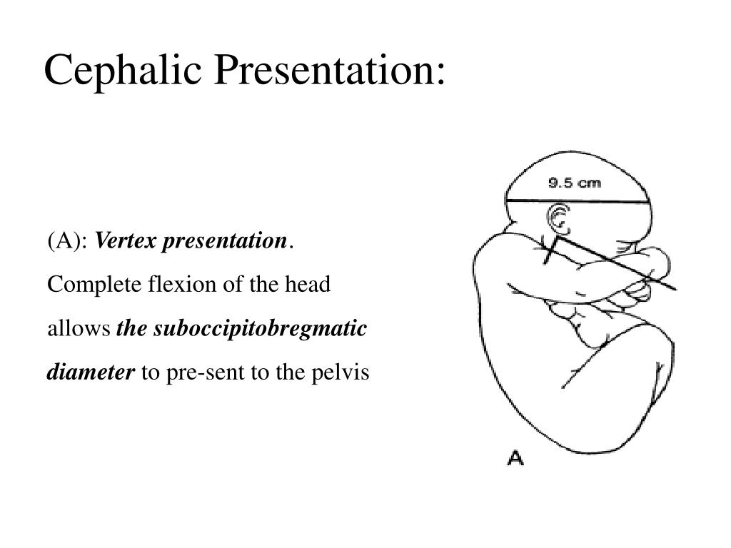 cephalic presentation vertex