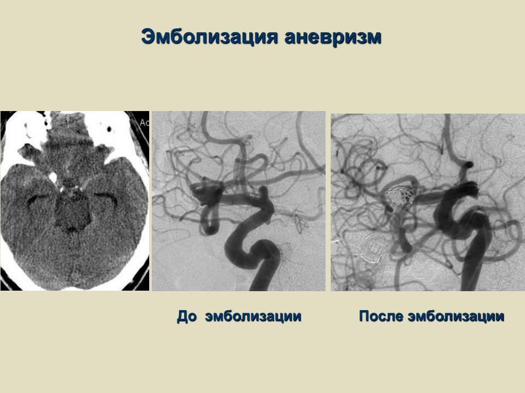 Эндоваскулярная операция головного мозга. Чрескожная эмболизация. Эмболизация аневризмы спиралью.