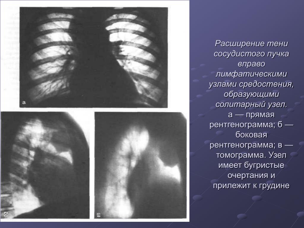 Сосудистая тень. Расширение средостения вправо на рентгене. Расширение тени верхнего средостения рентген. Расширение тени средостения рост размеров корня. Расширение тени средостения на рентгене.