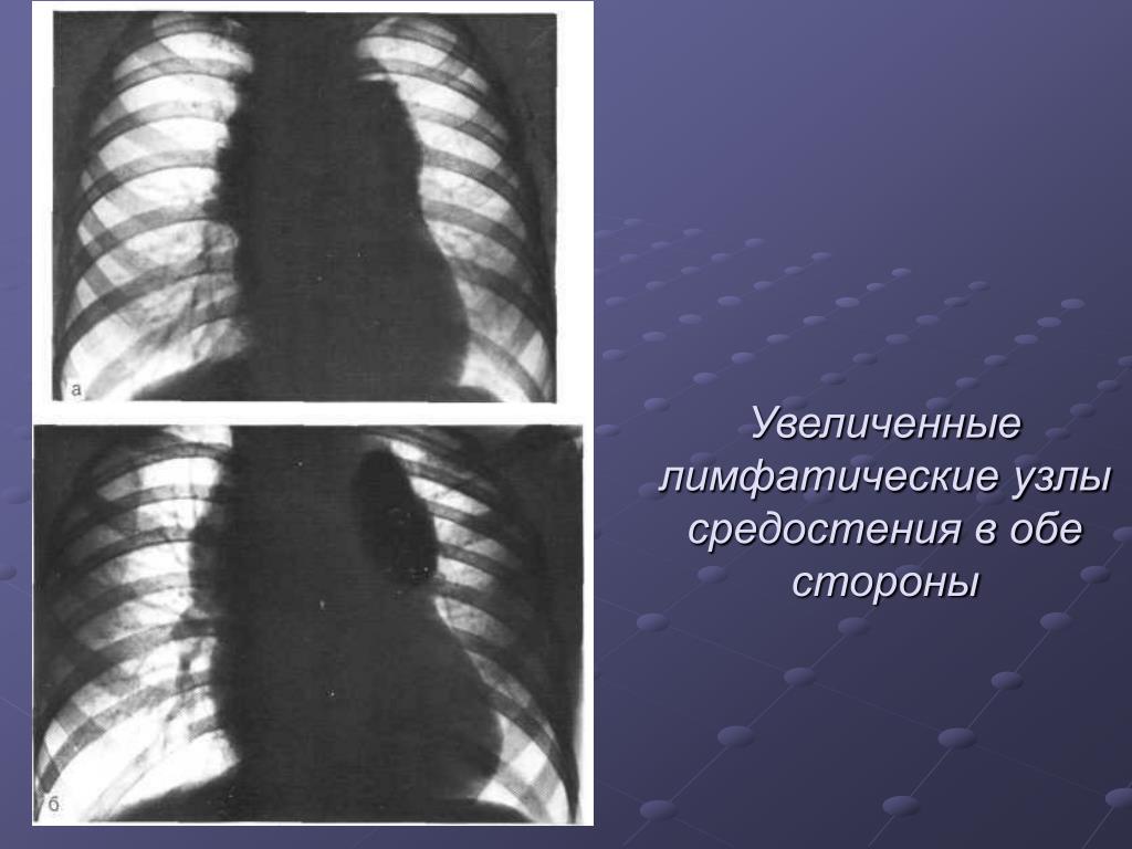 Легкие увеличен узел. Узлы средостения. Лимфоузлы средостения увеличены. Лимфатические узлы средостения. Лимфатические узлы средостения увеличены.