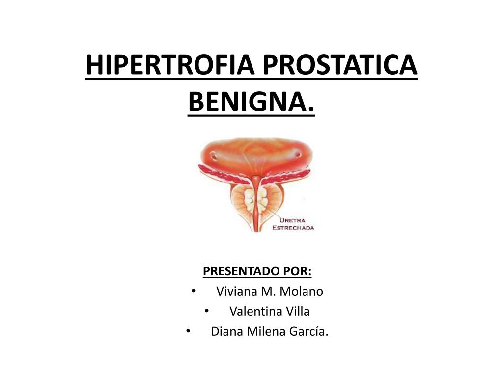 hiperplasia prostatica benigna pdf slideshare eliminarea toxinelor cu prostatita