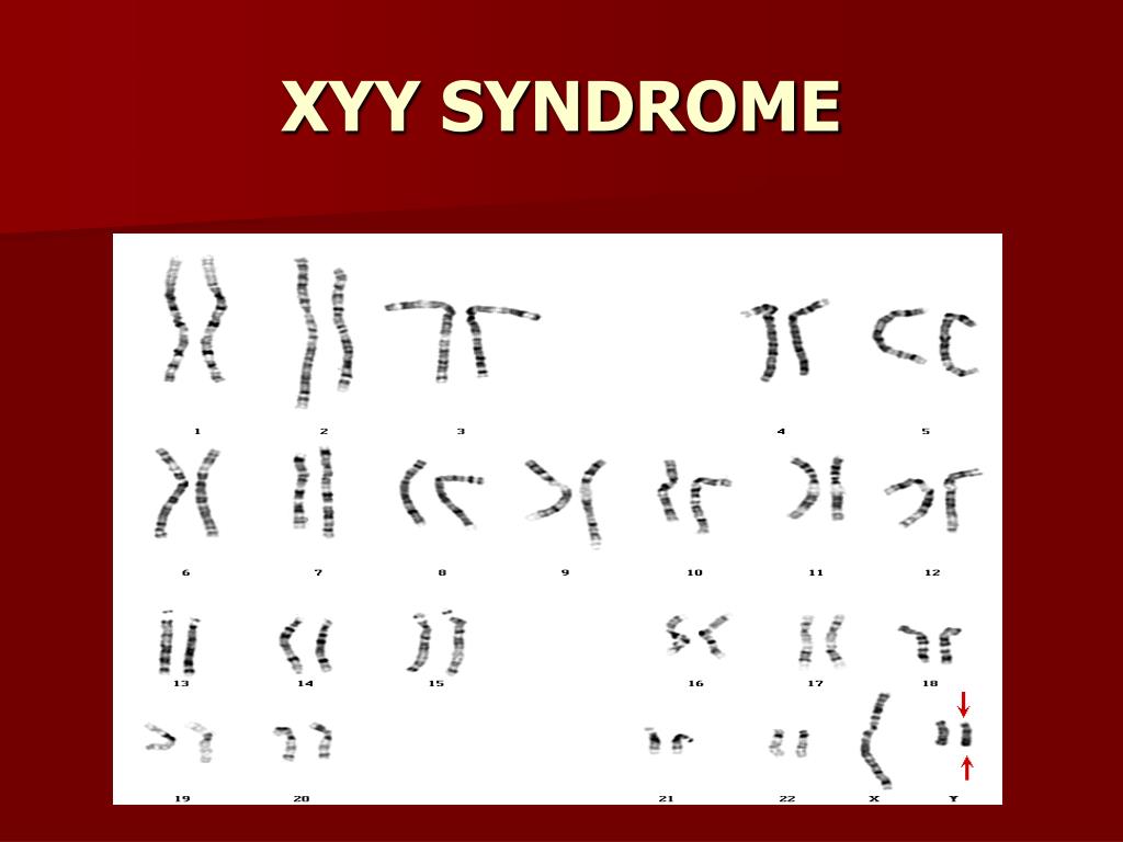 Синдром xyy фото