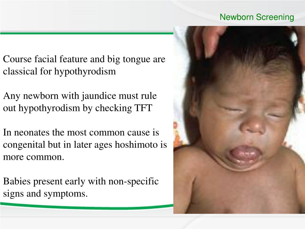 PPT - Common Thyroid Disorders in Children PowerPoint Presentation