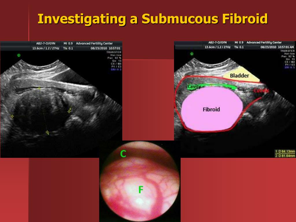 powerpoint presentation on uterine fibroids