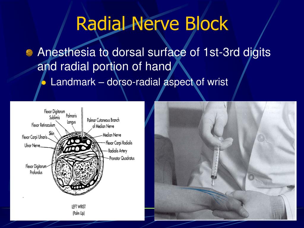 [17+] 4ulnar Nerve Block Cpt Code, Peripheral Nerve Blocks For Hand
