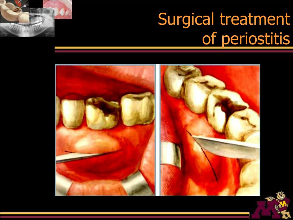 PPT - PERIAPICAL DISEASE PowerPoint Presentation, Free Download - ID ...