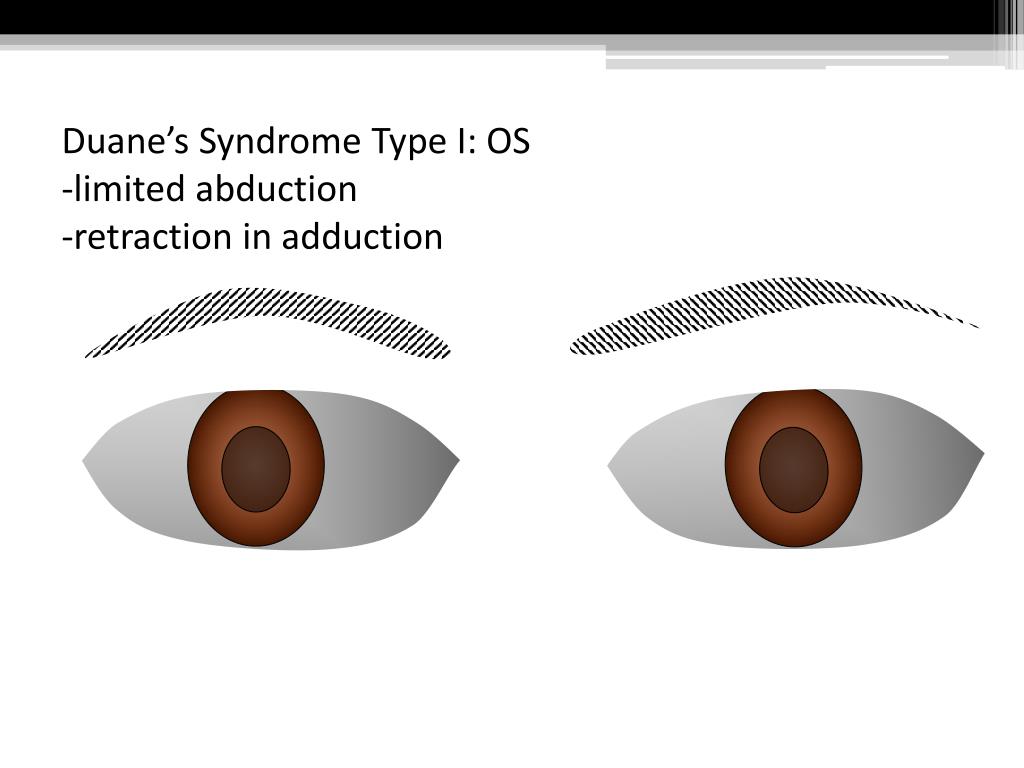 PPT Duane’s Retraction Syndrome PowerPoint Presentation, free