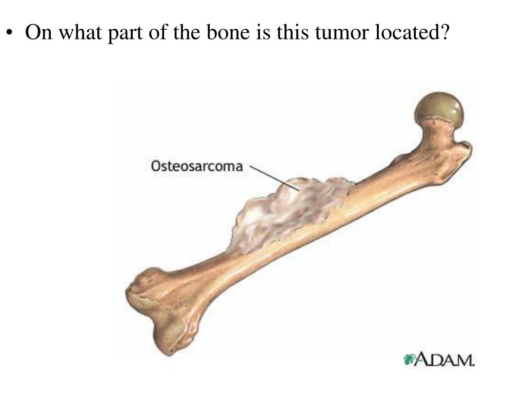Рак кости ноги. Саркома трубчатых костей. Саркома бедренной кости. Остеосаркома кости голени. Остеогенная саркома кости.