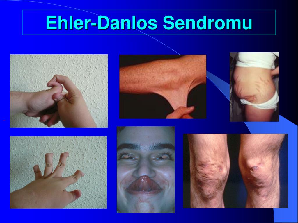 Ehler-Danlos Sendromu.