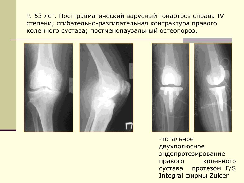Контрактура сустава код по мкб 10. Артроз коленного сустава эндопротез. Вальгусная деформация коленных суставов рентген степени. Деформация сустава гонартроз. Контрактура коленного сустава рентген.