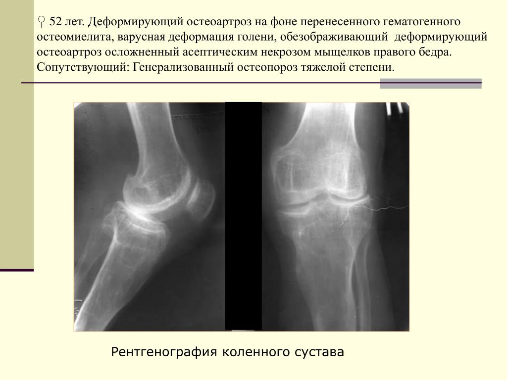 Некроз мыщелка бедренной. Остеонекроз коленного сустава рентген. Постковидный асептический некроз. Асептический некроз большеберцовой кости коленного сустава кт. Асептический некроз коленного сустава рентген.
