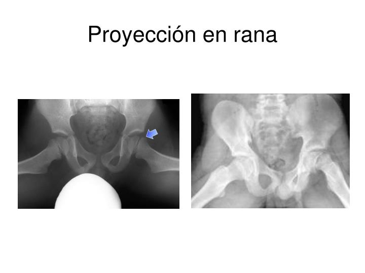 PPT - Osteomielitis aguda PowerPoint Presentation - ID:6111212