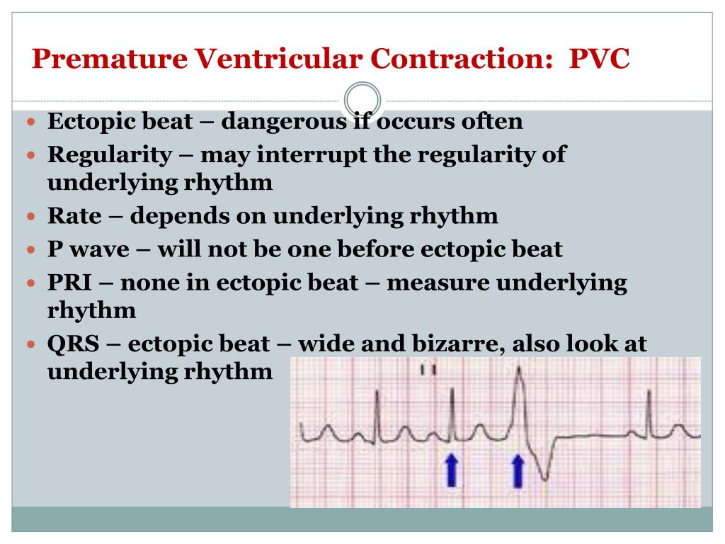 PPT - Cardiovascular Monitoring Cardiac Dysrhythmia PowerPoint ...