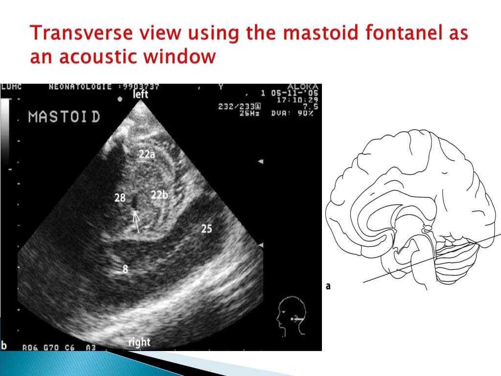 PPT - Neonatal Cranial Ultrasound (Part 1: Technical ...