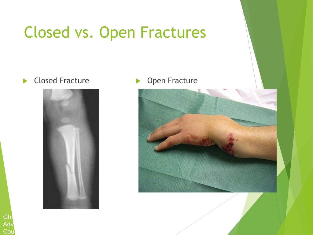 open vs closed fracture open vs closed fracture