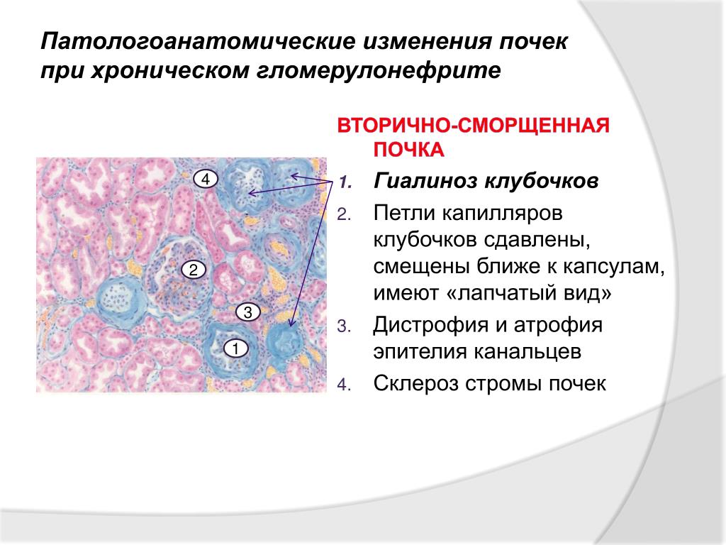 Микро изменение. Хронический гломерулонефрит микропрепарат. Хронический пиелонефрит гистология. Гломерулонефрит патанатомия. Сморщенная почка макропрепарат.