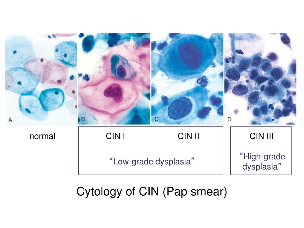 Интраэпителиальное поражение hsil. Цитология дисплазия эпителия. Дисплазия клеток плоского эпителия. Дисплазия эпителия шейки матки цитология. Cin 2 шейки матки цитология.