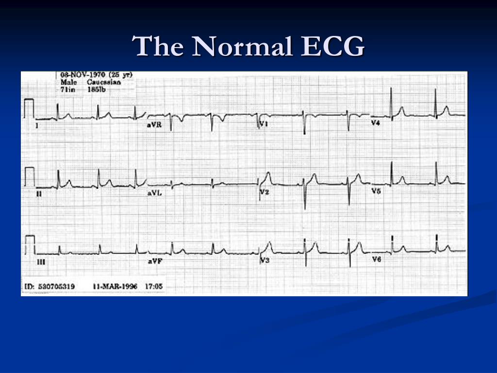 Normal ECG Chart