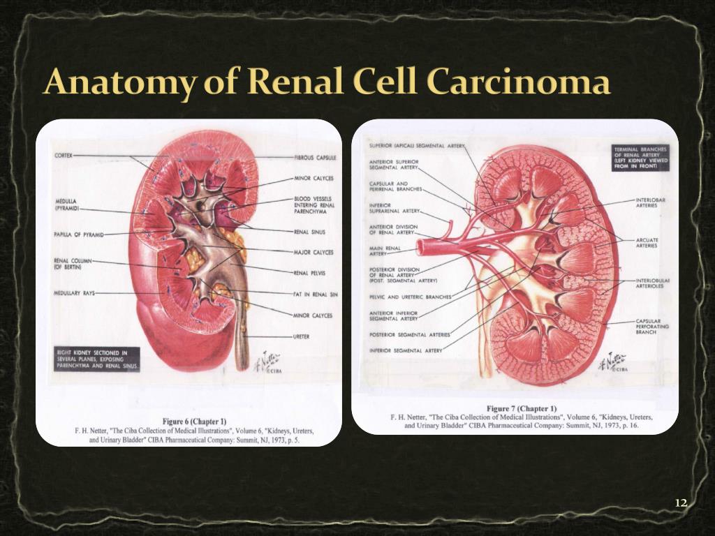 initial presentation of renal cell carcinoma
