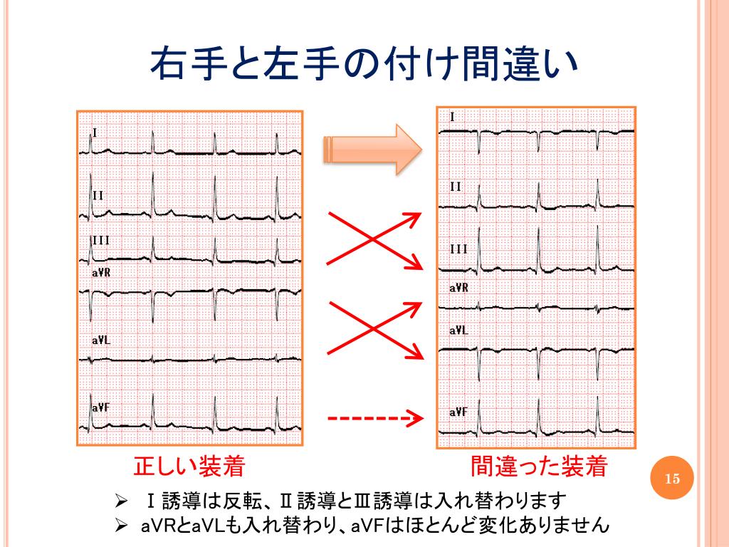 ユニーク 12誘導心電図 貼り方 女性 胸 さのばりも