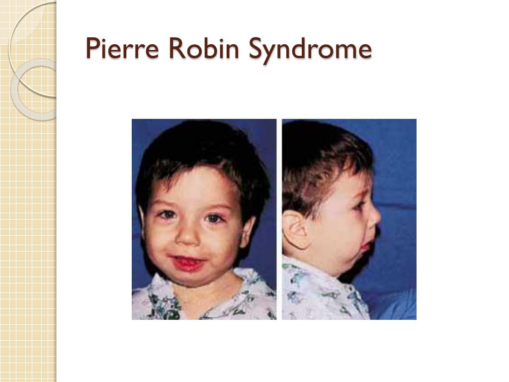 pierre robin sequence adults pierre robin sequence adults