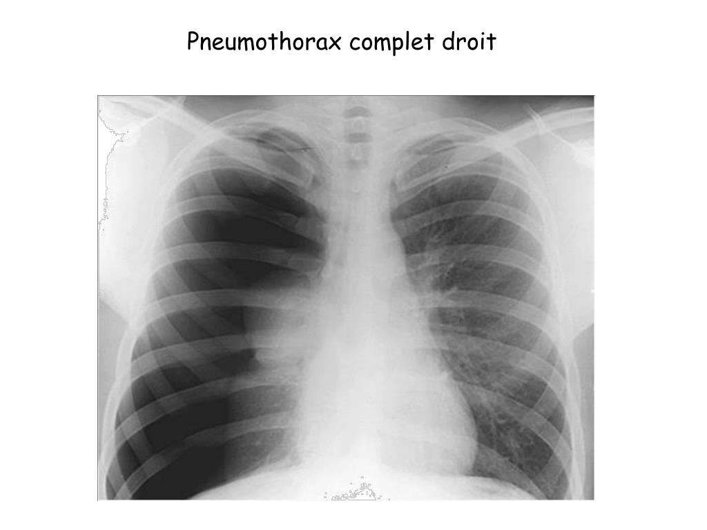 Коллапс легкого это. Спонтанный пневмоторакс рентген. Пневмоторакс рентген. Рентгенограмма грудной клетки пневмоторакс. Пневмоторакс рентген снимки.