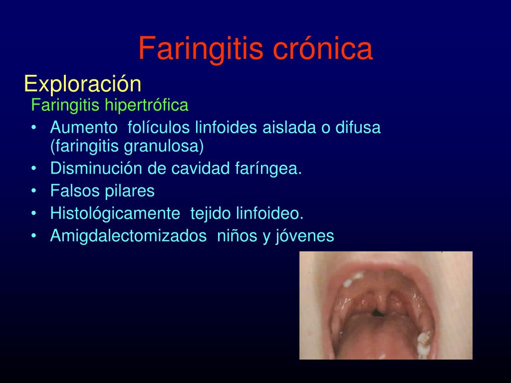 Pathway Faringitis