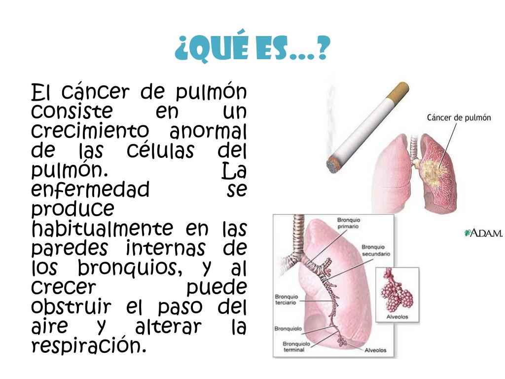Síntomas de recidiva cáncer pulmón