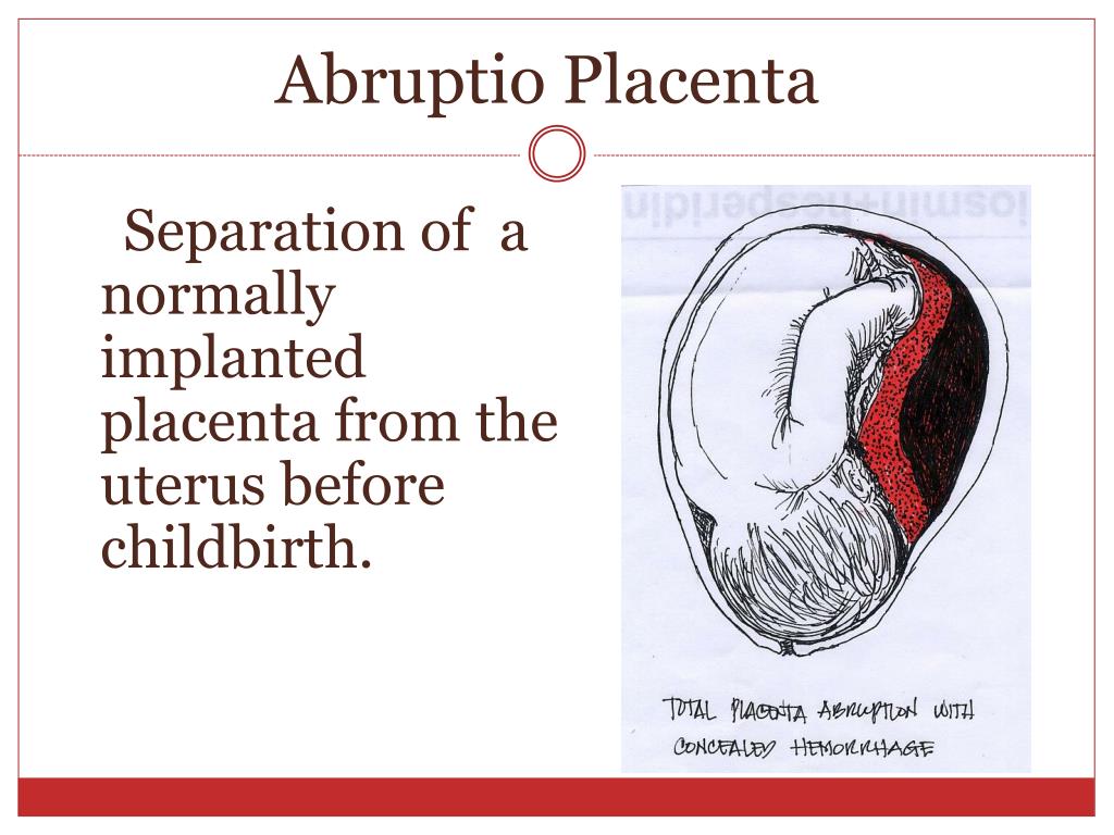 PPT - Pregnancy Complications PowerPoint Presentation ...