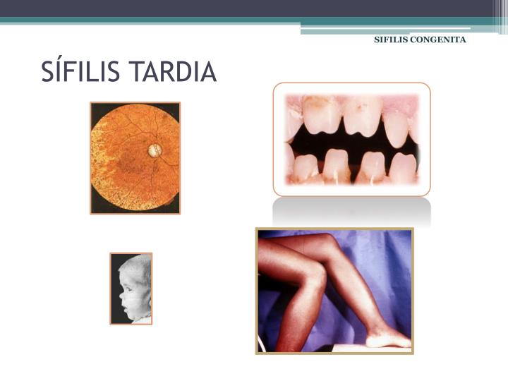 PPT - SIFILIS CONGENITA PowerPoint Presentation - ID:6190309