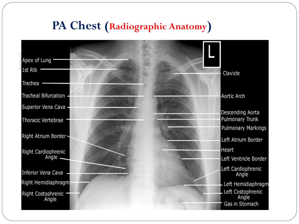 PPT - Chest Radiography LECTURE.2 PowerPoint Presentation - ID:6197912