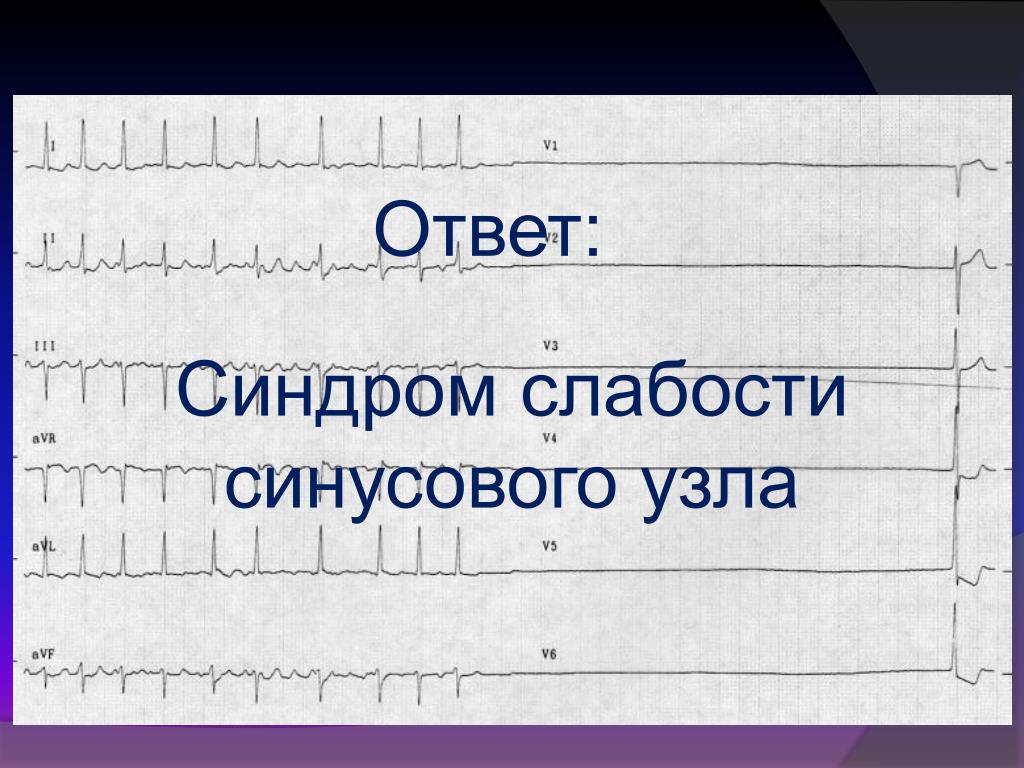 Слабость синусового узла мкб. Синдром слабости синусового узла на ЭКГ. Слабость синусового узла. Синдром слабости синусового узла причины. Синдром слабости синусового узла код.