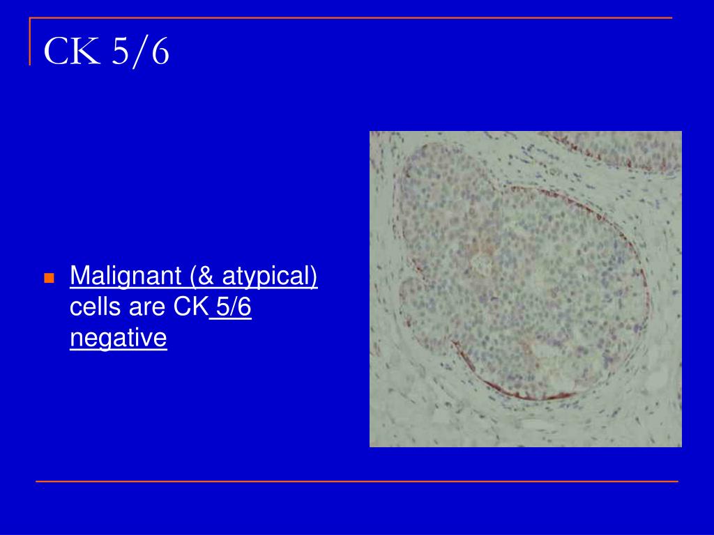 Ppt New Issues In The Interpretation Of Breast Biopsies Powerpoint Presentation Id