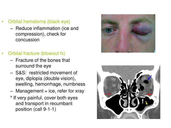 What Is Orbital Hematoma At Frances Chavez Blog What Is Orbital Hematoma At Frances Chavez Blog